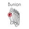 Bunion in foot vector illustration