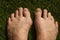 Bunionccomparison left foot versus normal right foot