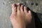 Bunions hallux valgus