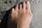 Bunions hallux valgus