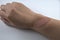 Burn scar on forearm on white background