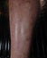 Burn scar on male leg