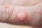 Burned skin on a finger of Caucasians man hand - closeup