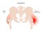 Bursitis inflammation concept