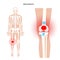 Bursitis inflammation concept