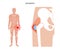 Bursitis inflammation concept