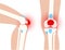 Bursitis inflammation concept