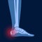 Bursitis inflammation concept