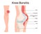 Bursitis. Knee joint inflammation. Inflamed or irritated bursae of synovial
