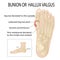 Bursitis on the sides of the foot. The bone and skin on the sides of the big toe joint .