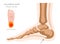 Calcaneal spur. Plantar fasciitis set. Medical desease infographics collection