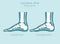 Calcaneal spur. Plantar fasciitis set. Medical desease infographics collection