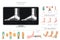 Calcaneal spur. Plantar fasciitis set. Medical desease infographics collection