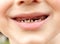 Calf\'s Teeth decay Toothache