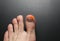 Callus blisters on man feet. Painful wounds. Uncomfortable shoes problems. Footballer`s legs