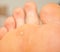 Callus and hyperkeratosis