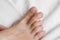 Calluses on female fingers close-up. The problem of uncomfortable shoes. Foot care concept