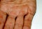 Calluses on the palm and fingers of the hand. Labor corns