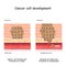 Cancer cell development. Tumor Formation