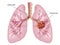 cancer lung pictures
