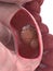 Cancer in small intestine
