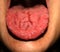 Candidiasis in the tongue. Fractured tongue. Thrush.