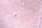 Capillary hemangioma, light micrograph