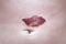 Capillary hemangioma regression. Red birthmark on the baby`s belly after treatment