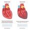 Cardiac arrest vs heart attack. Heart diseases comparison. Electrical signal