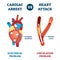 Cardiac arrest vs heart attack vector illustration. Labeled health problem.