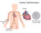 Cardiac catheterization