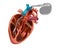 Cardiac pacemaker or artificial pacemaker.