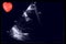 Cardiac ultrasound images and small heart . Doppler echo