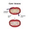 Care braces. Interdental brush teeth. Dental floss. Infographics. Vector illustration on background