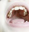 caries on milk upper chewing teeth