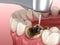 Caries removing process. Medically accurate tooth 3D illustration