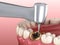 Caries removing process. Medically accurate tooth 3D illustration