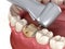 Caries removing process. Medically accurate tooth 3D illustration