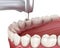 Caries removing process. Medically accurate tooth 3D illustration