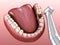 Caries removing process. Medically accurate tooth illustration