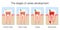 Caries Stages Development Tooth Decay Cross Sections