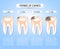 Caries stages of development. Visual aid for students, dentists, clinic patients. Defeat the source of destruction in the teeth. V