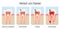 Caries Stages German Names Development Tooth Decay Cross Sections