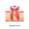 Caries Tooth Anatomy
