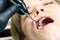 Caries treatment to chewing side tooth upper jaw