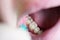 Carious lesions on chewing teeth, dental caries, aesthetic defect