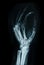 Carpal bones Human X Ray.