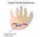 Carpal tunnel syndrome