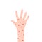 cartoon hand with rash like allergy