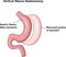 Cartoon illustration of Vertical Sleeve Gastrectomy (VSG)